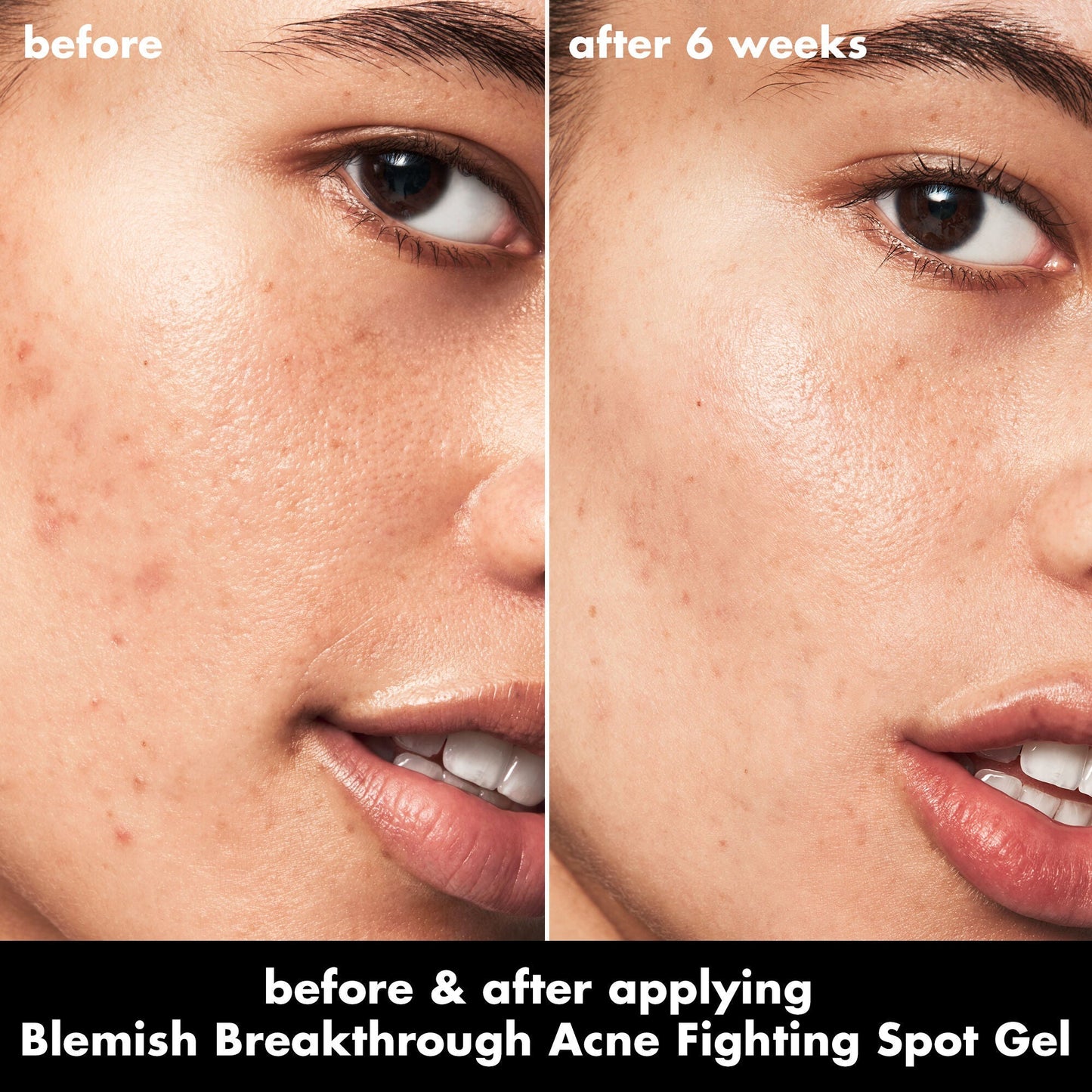 blemish-breakthrough-acne-fighting-spot-gel-z4 0326_EDU_BB_SpotGel_BA_ISABELLA.jpg