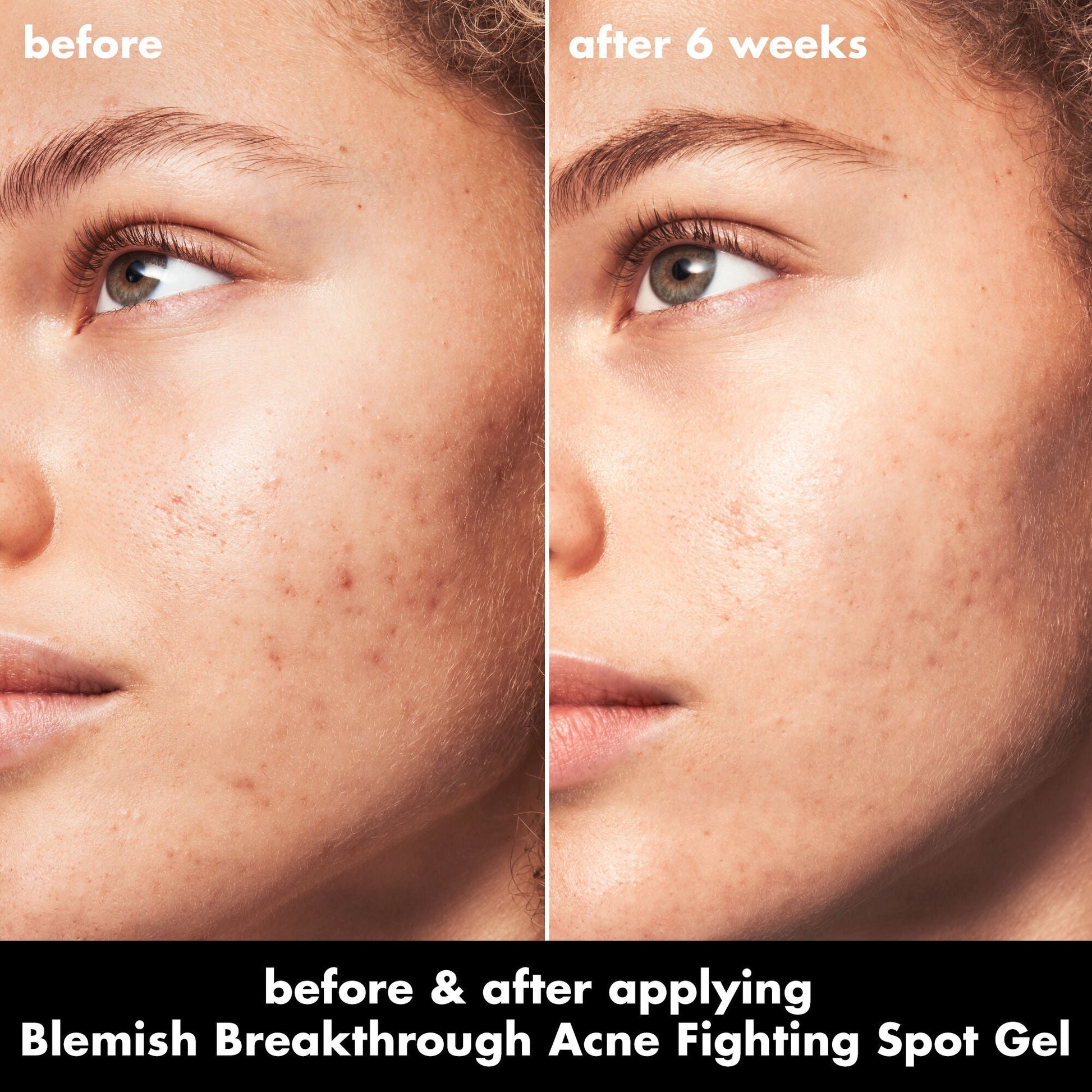 blemish-breakthrough-acne-fighting-spot-gel-z4 0326_EDU_BB_SpotGel_BA_MARLEY.jpg