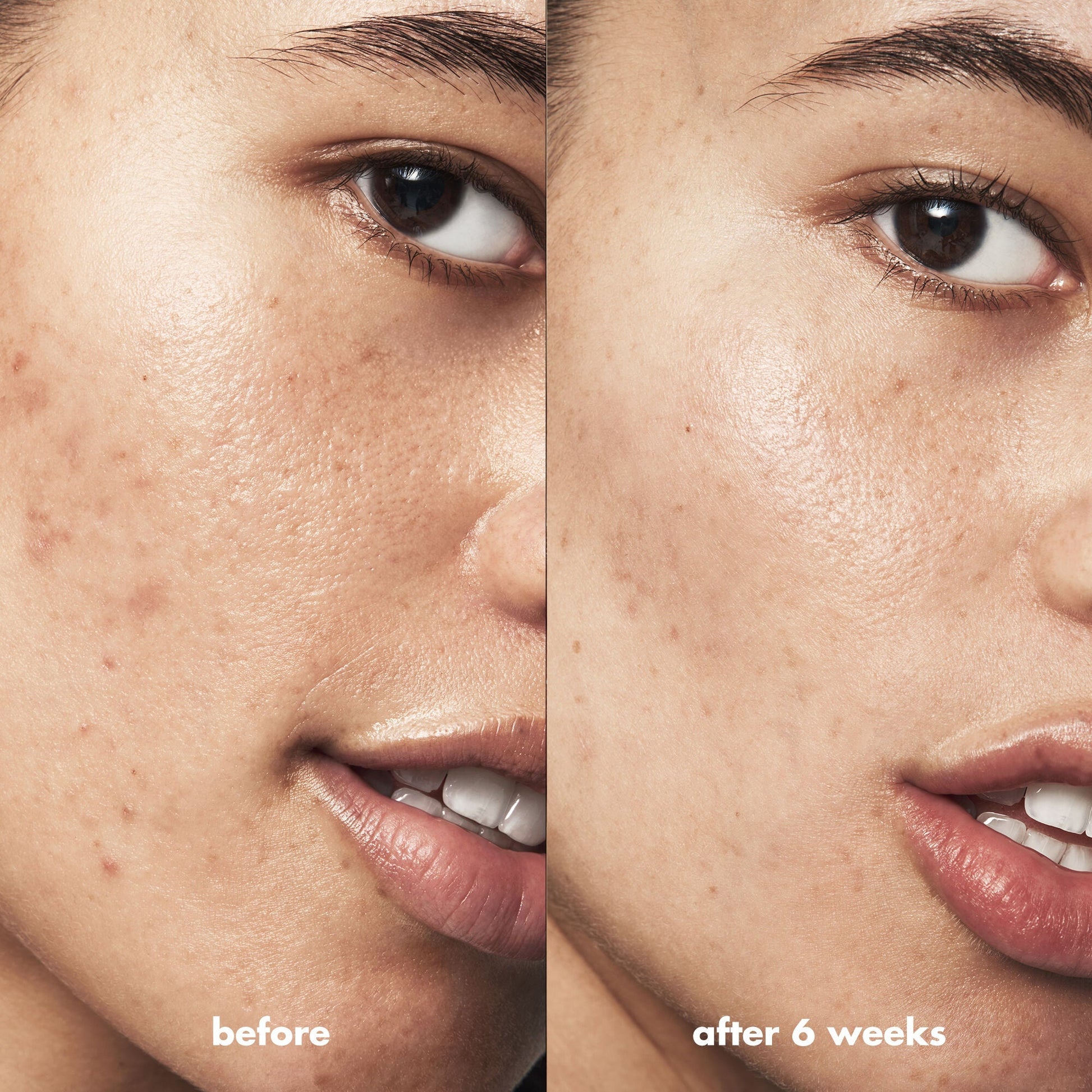 blemish-breakthrough-acne-clarifying-cleanser-p6 Acne_PDP_Isabella_Before_After_a3ff322b-cc6f-4b1a-9db3-bfb66c15d034.jpg