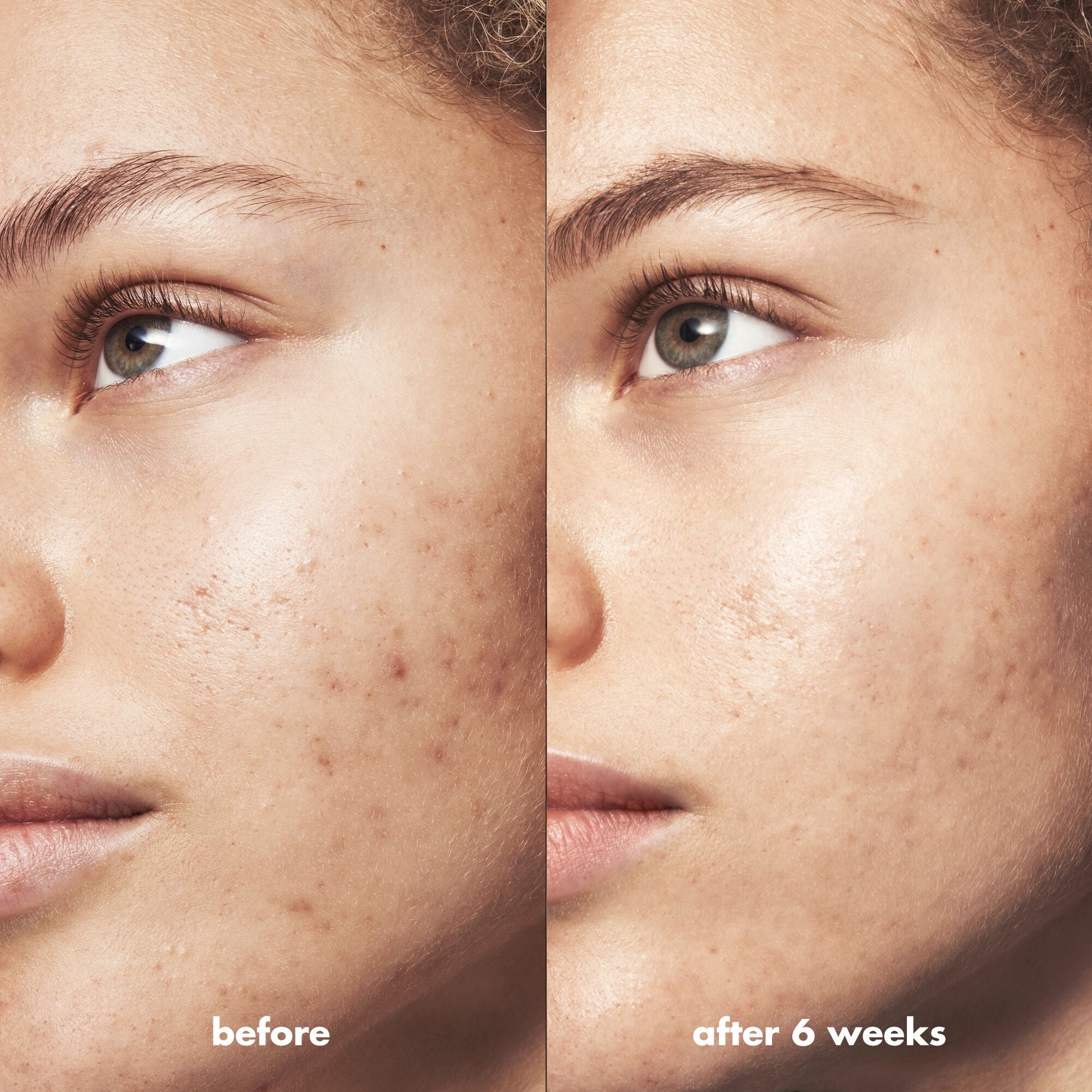 blemish-breakthrough-acne-calming-water-cream-mini-y8 Acne_PDP_Marley_Before_After_acf01478-a58b-47ce-99b5-2ef1dc022f9b.jpg
